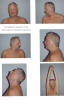 Nackr�relser efter operation